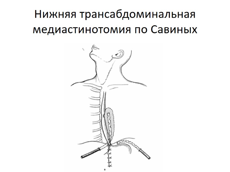 Нижняя трансабдоминальная медиастинотомия по Савиных
